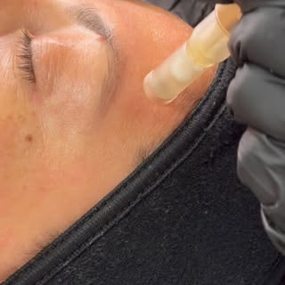 Glowy skin starts with the right treatment ✨ 

Microneedling improves the appearance of fine lines, 