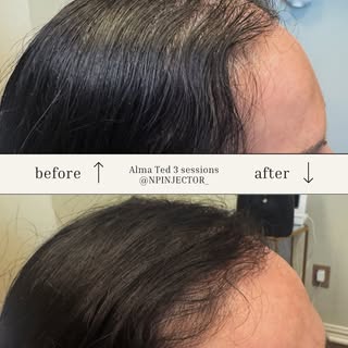 ALMA TED HAIR RESTORATION 
Results after 3 treatments👏 
-No Needles
-No Discomfort 
-No Trauma 

#a