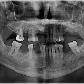 ✨ Transform Your Smile in Turkey with AIO! ✨
Looking for high-quality dental implants or a bright, n