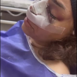 -
Two Major Transformations in One Trip! 
Day 1 footage, right after the simultaneous surgeries:
Rhi