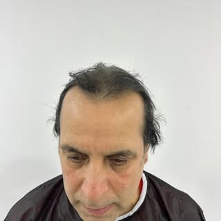 Sapphire Hair Transplant at AIO ✨
Advanced Sapphire FUE for natural, dense results.
Precision • Mini