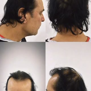 – Luxury / VIP

Premium Sapphire Hair Transplant 💎
VIP care • Natural results#hairtransplant #befor