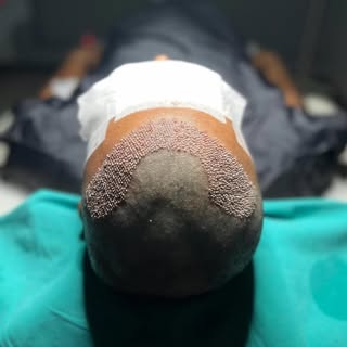1 decision. 1 procedure.
A lifetime of confidence.
Before ➡️ After hair transplant at AIO
#HairTrans