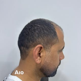 Get Your Hair Back with Sapphire FUE 💎
High Density • Natural Hairline
Trusted International Patien