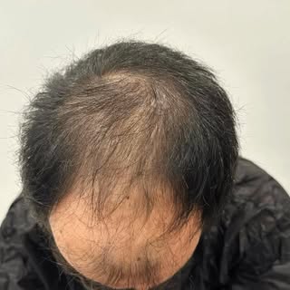 ✨ Natural Hair Transplants in Turkey
🇹🇷 FUE • DHI • Sapphire Techniques
🏥 VIP Medical Tourism in 