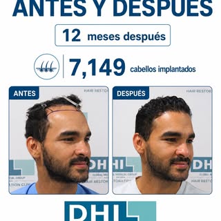 Un cambio real, sin cirugía tradicional. 💈

7,149 cabellos implantados con la técnica DHI: mínimame