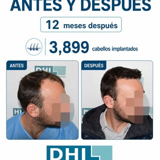 Los detalles marcan la diferencia. 🎯

Con 3,899 cabellos redefinimos entradas y línea frontal usand