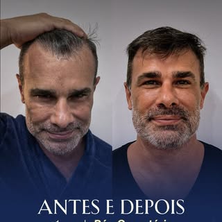 Mais de 1 ano depois… e o resultado continua falando por si.

O transplante capilar não muda apenas 