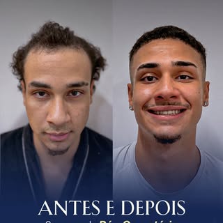 6 meses depois, o Caio Victor já consegue ver no espelho a mudança que tanto esperava.

O transplant