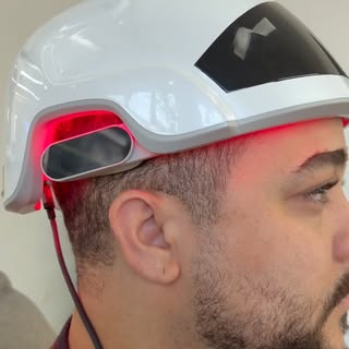 PRP Capilar (Plasma Rico em Plaquetas)
Sessões antes do transplante capilar na @nolascohairoficial 
