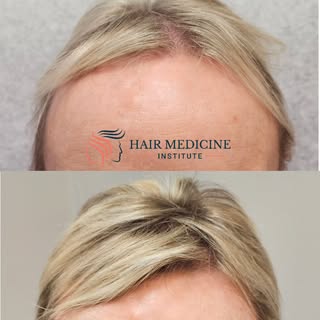 Before ➡️ 6 months after.
No procedures. No gimmicks. Just biology.
This is what consistent medical 
