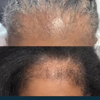 She thought her edges were gone for good. They weren't.

Years of tight braids, weaves, and hot comb