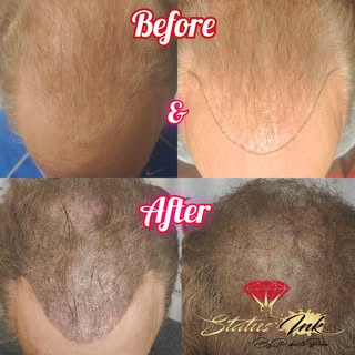 Wow!! Just look at the life changing results for this client !! He no longer has to to use hair fibe