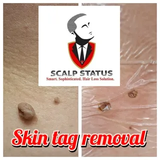 Let me help you boost your confidence by removing unwanted skin tags that you've been putting off fo