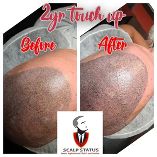 This client came in for a two-year touch up with scalp micropigmentation this procedure works well f