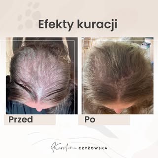 Efekty kuracji 🫶🏻 ogromnie się cieszę, że ta kobietka zrobiła taki progres w wielu aspektach pod m