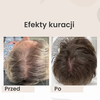 Jak Wam się podobają efekty kuracji ❓
W poniedziałek zapraszam Was do obejrzenia Pytanie na Śniadani