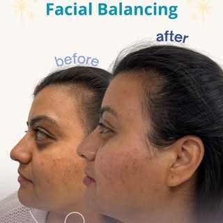 Facial balancing, redefined ✨

Swipe to see the transformation: a full facial balancing treatment de