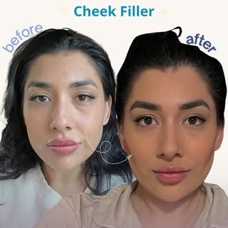 ✨ Cheek Filler Transformation ✨

Our patient wanted to enhance their cheek contour and regain some l