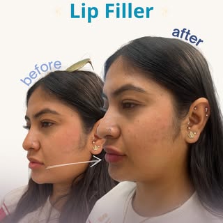 Swipe to see the difference Restylane Kysse can make 👀

This patient came to our Los Altos office w