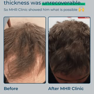 When Drew first came to MHR Clinic, he believed his hair thickness was beyond recovery. Years of thi