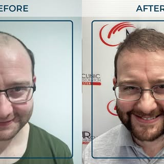 Andrew has undergone a comprehensive hair restoration journey with MHR Clinic, including an FUE tran