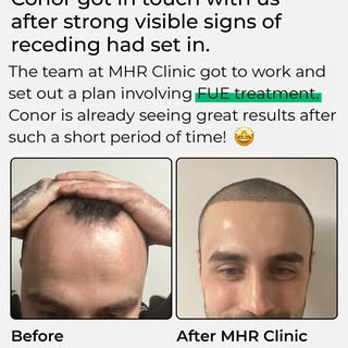 The early progress from Conor’s FUE hair restoration journey with MHR Clinic is already looking incr
