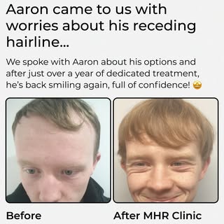 Meet Aaron 🌟 When Aaron first came to MHR Clinic, he was concerned about his receding hairline and 