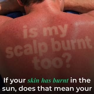 ☀️ If your skin has burnt in the sun, does that mean your scalp has too? The answer is: quite possib