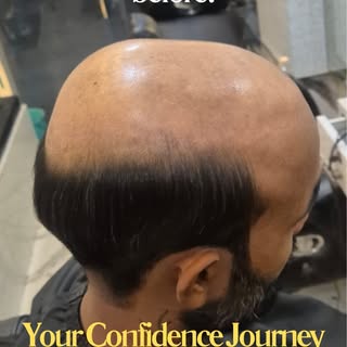Stop letting hair loss control your confidence.

Look at this transformation. A premium hair patch i