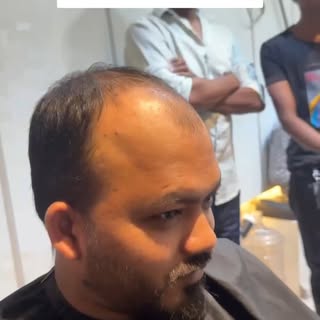 Suffering from hair loss or thinning? Get 100% Natural Hair Transformation instantly at Arsalan Salo