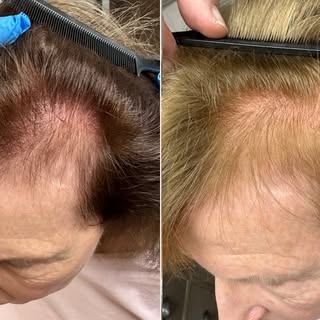 10 month follow up - Laterals and hair lines are filling in nicely.