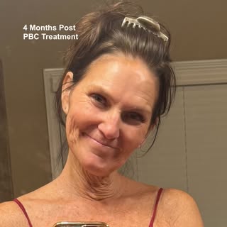 Pamela Kruse - 4 month Post Treatment. It is so rewarding restoring women's hair, Especially when it