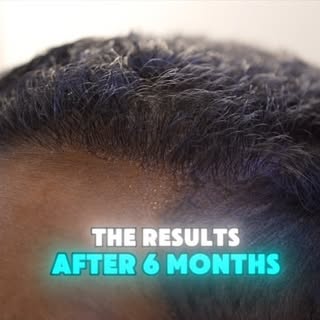 🌟 Transforming my look, one strand at a time! 💇‍♂️✨ Excited to share my hair restoration journey! 