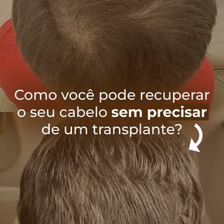 Receber um diagnóstico de calvície não significa, automaticamente, que o transplante seja a melhor o