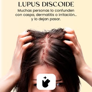 ¿Pensabas que era solo caspa o una dermatitis común?

El Lupus Discoide suele comenzar de forma suti