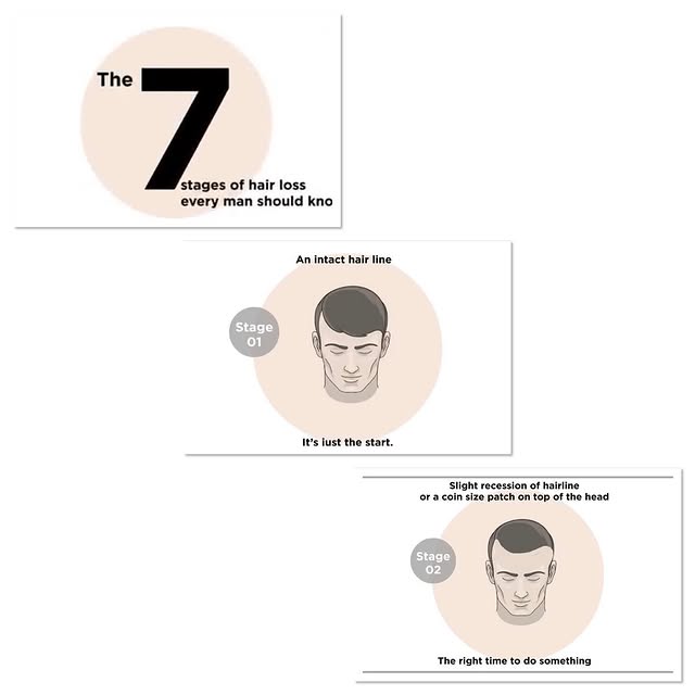 Solution of Your Baldness, Hair360 Trichology Center, Kharadi,Pune