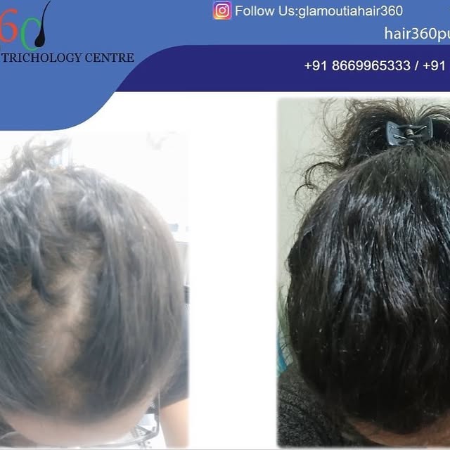#hair360treatments #hair #hairtransformation #hairtreatment #hair360 #bestresults #healthyhair