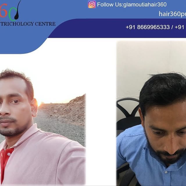 Magic of Hair360 Trichology Center