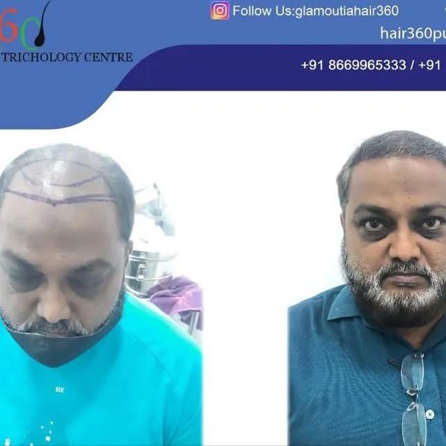 For The Best Results, Hair360 Trichology Center,Kharadi,Pune 
#hair #hairtransplants #hairgrowth #ha