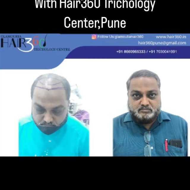 #hair360treatments #hair360 #trichology #hairstyles #hair #hairtransformation #hairtransplant #healt