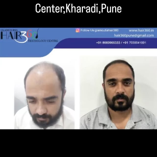 #hair #hairstyles #hairtransformation #hairtransplant #trichologist #pune 

Contact Hair360 Tricholo