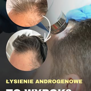 Czy z łysieniem androgenowym trzeba się pogodzić? 
Tak, jest to łysienie przewlekłe, postępujące. 
A