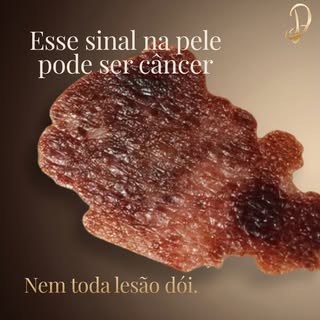 Nem toda lesão dói, fique atendo aos sinais. Diagnóstico precoce salva vidas.

Dr. Lúcio de Lima Dua