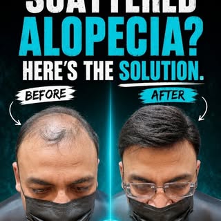 🔥 Is patchy hair loss affecting your confidence?
💯 Discover how scattered alopecia can be treated 