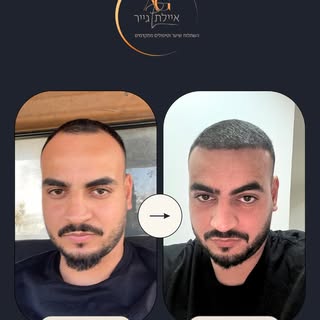 אנחנו יודעים שגם אתם בהלם מזה שמדובר בהשתלת שיער מרוב שזה נראה טבעי 🫠
משיער דליל בחלק הקדמי  לשיער 