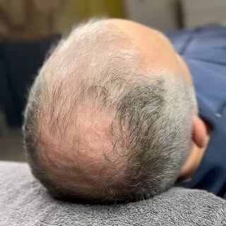 UP AGAIN 😎
________________________________________________
#smp #scalp #scalpmicropigmentation #ha