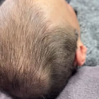 Unglaubliche Verwandlung! ✨ Vorher vs. Nachher – für einen volleren Look. #Haarpigmentierung #ScalpA