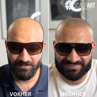 New hairline ✅
New sunglasses ✅
New life ✅
________________________________________________
#smp #ha