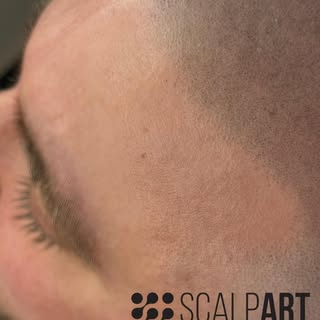 Nur eine Haarlinie, die aussieht, als wäre sie schon immer da gewesen.

Buche jetzt deine persönlich